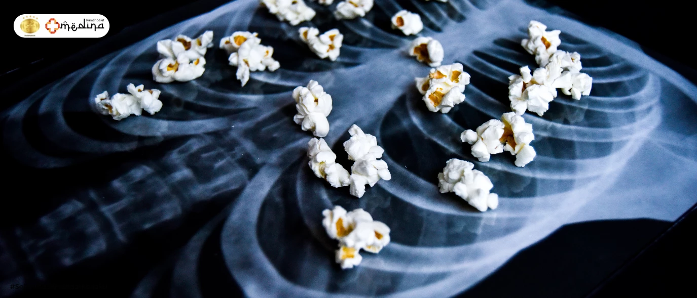 artikel kesehatan Popcorn Lung: Penyakit Berbahaya Akibat Kebiasaan Merokok